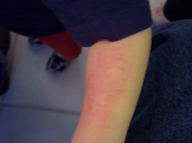 Mon 05 Nov 2007 02:40:02 PM

Andrew began breaking out in hives this weekend, and for reasons we don't, and may never, know.  We're hoping and praying they stop soon...