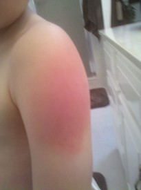 Fri 06 Aug 2010 04:00:50 PM

Andrew had a bad reaction to one of his pre-Kindergarten vaccinations.